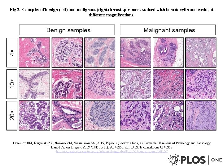 Fig 2. Examples of benign (left) and malignant (right) breast specimens stained with hematoxylin