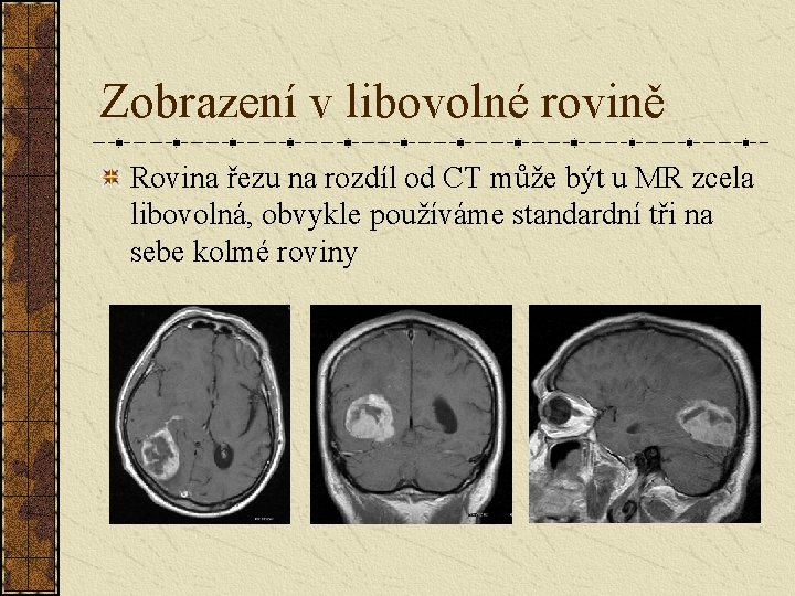 Zobrazení v libovolné rovině Rovina řezu na rozdíl od CT může být u MR Zobrazení v libovolné rovině Rovina řezu na rozdíl od CT může být u MR