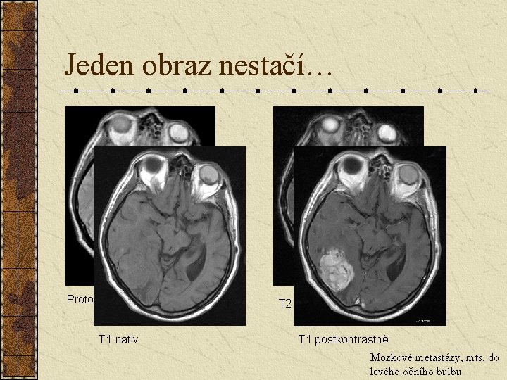 Jeden obraz nestačí… Protonová denzita (PD) T 1 nativ T 2 T 1 postkontrastně Jeden obraz nestačí… Protonová denzita (PD) T 1 nativ T 2 T 1 postkontrastně