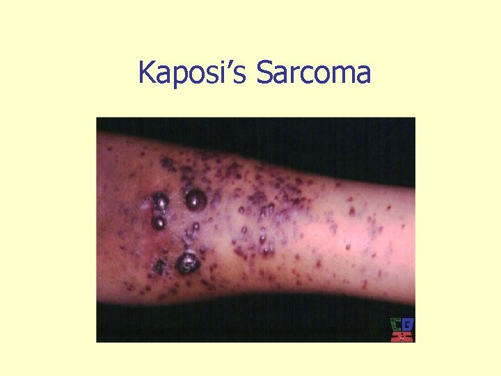 Kaposi’s Sarcoma 