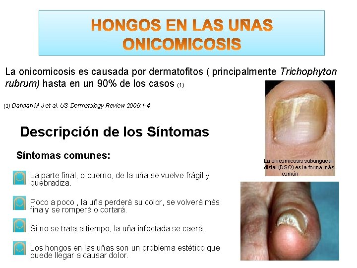 La onicomicosis es causada por dermatofitos ( principalmente Trichophyton rubrum) hasta en un 90%