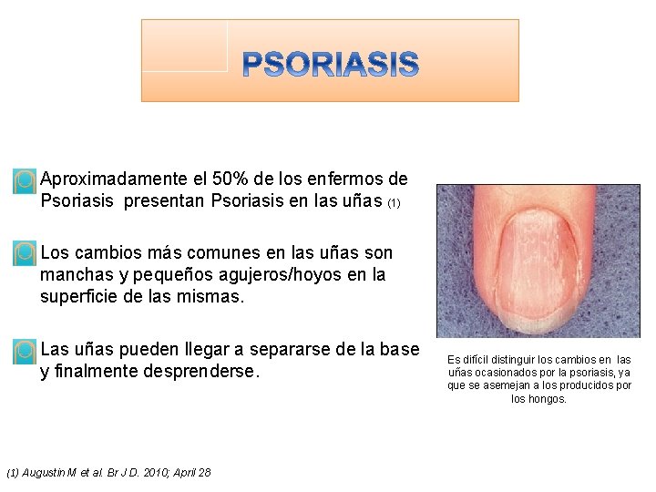 Aproximadamente el 50% de los enfermos de Psoriasis presentan Psoriasis en las uñas (1)