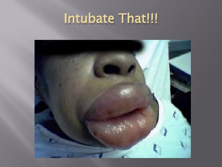 Intubate That!!! 