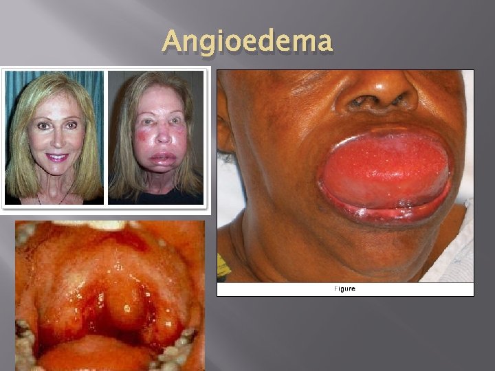 Angioedema 