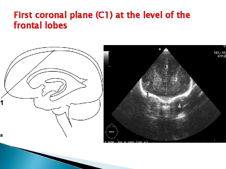 First coronal plane (C 1) at the level of the frontal lobes 