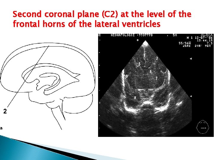Second coronal plane (C 2) at the level of the frontal horns of the
