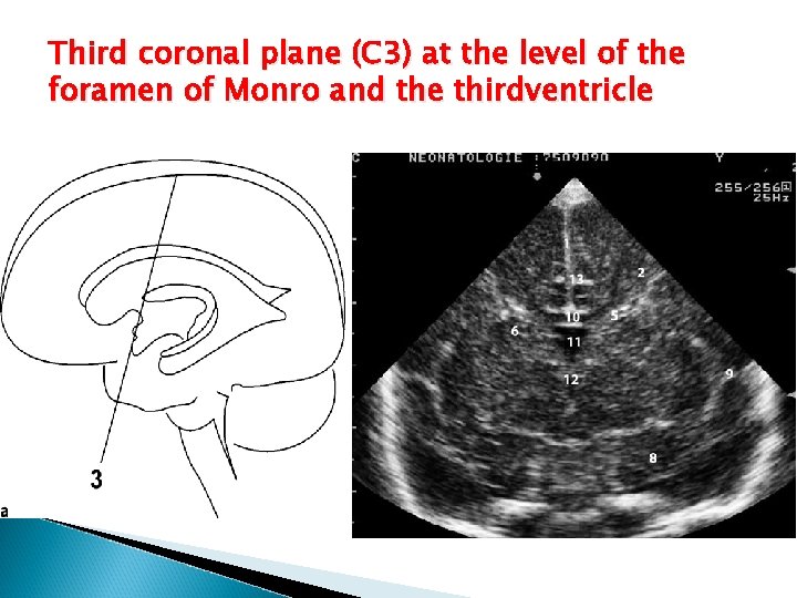 Third coronal plane (C 3) at the level of the foramen of Monro and
