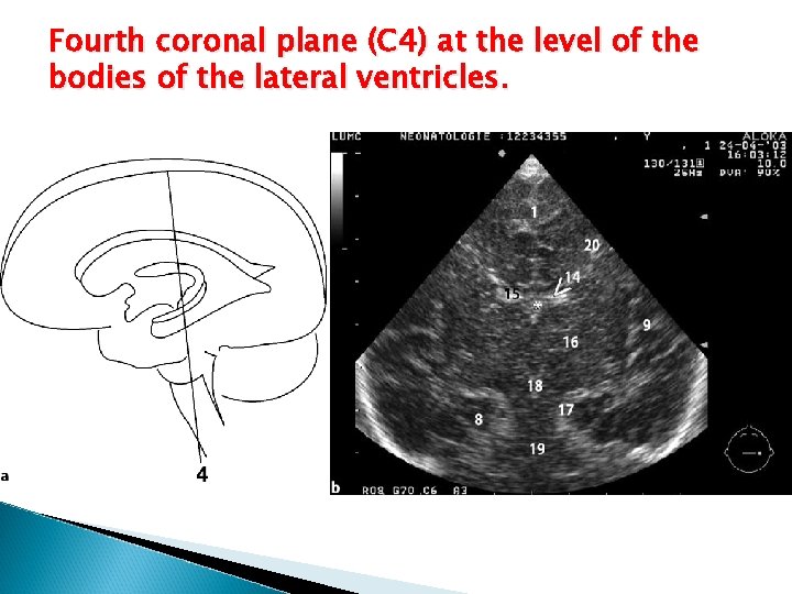 Fourth coronal plane (C 4) at the level of the bodies of the lateral