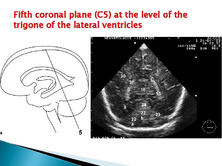 Fifth coronal plane (C 5) at the level of the trigone of the lateral