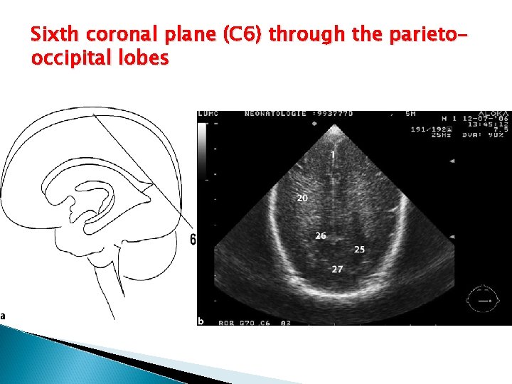 Sixth coronal plane (C 6) through the parietooccipital lobes 