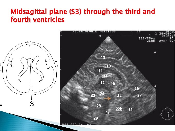 Midsagittal plane (S 3) through the third and fourth ventricles 