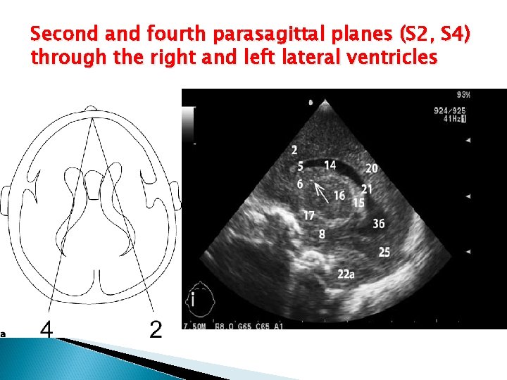 Second and fourth parasagittal planes (S 2, S 4) through the right and left