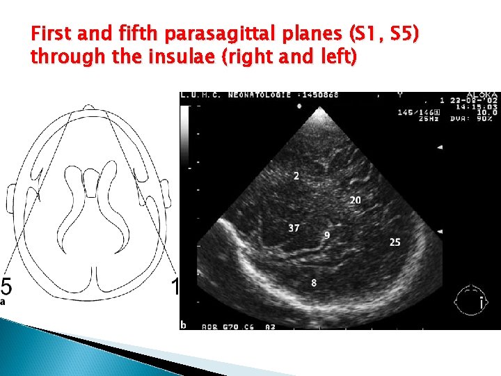 First and fifth parasagittal planes (S 1, S 5) through the insulae (right and