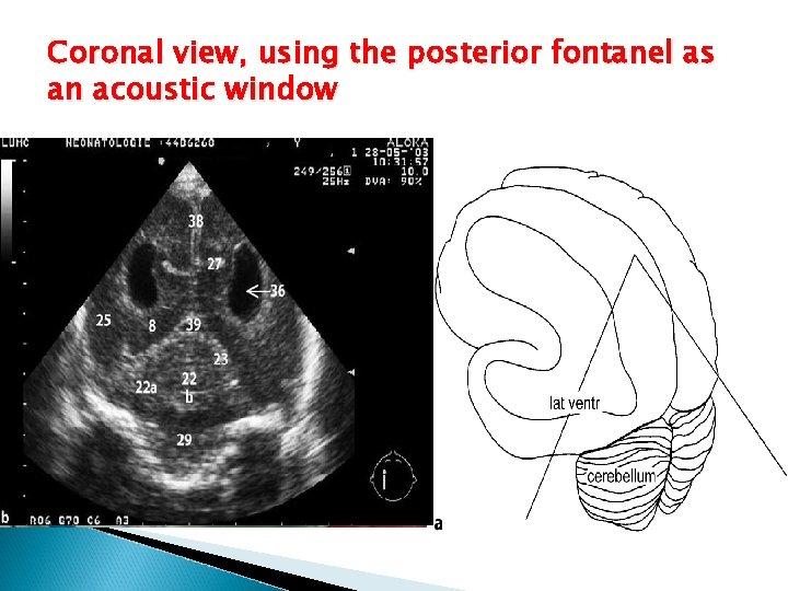 Coronal view, using the posterior fontanel as an acoustic window 