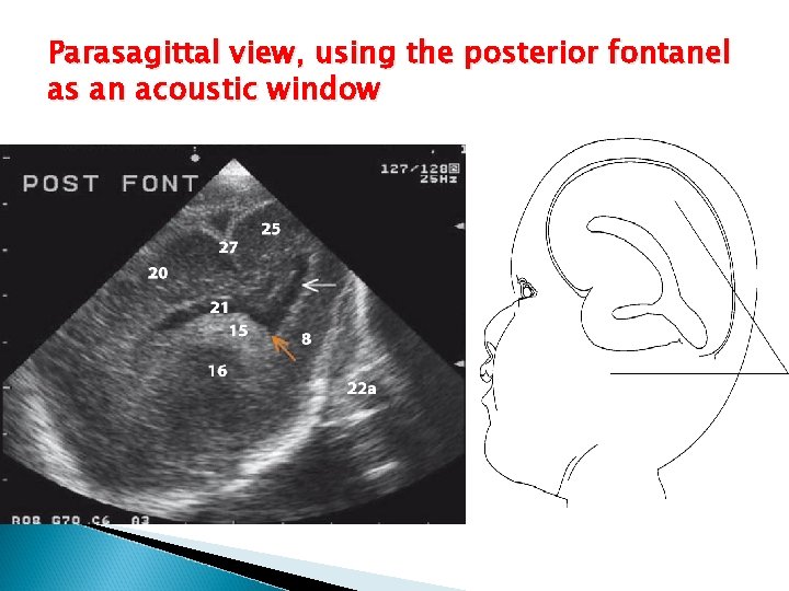 Parasagittal view, using the posterior fontanel as an acoustic window 