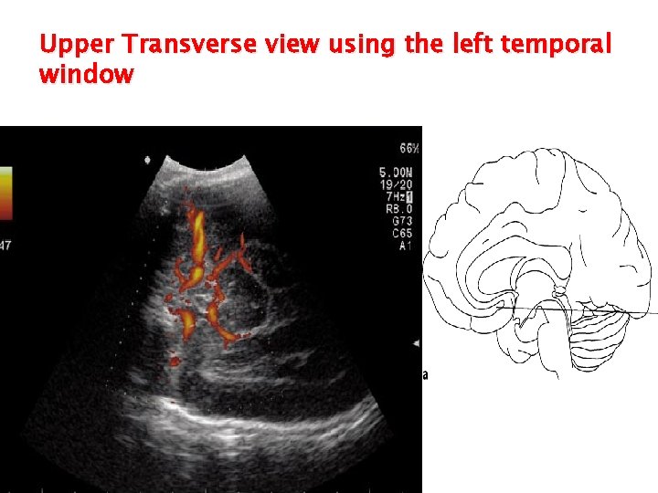 Upper Transverse view using the left temporal window 