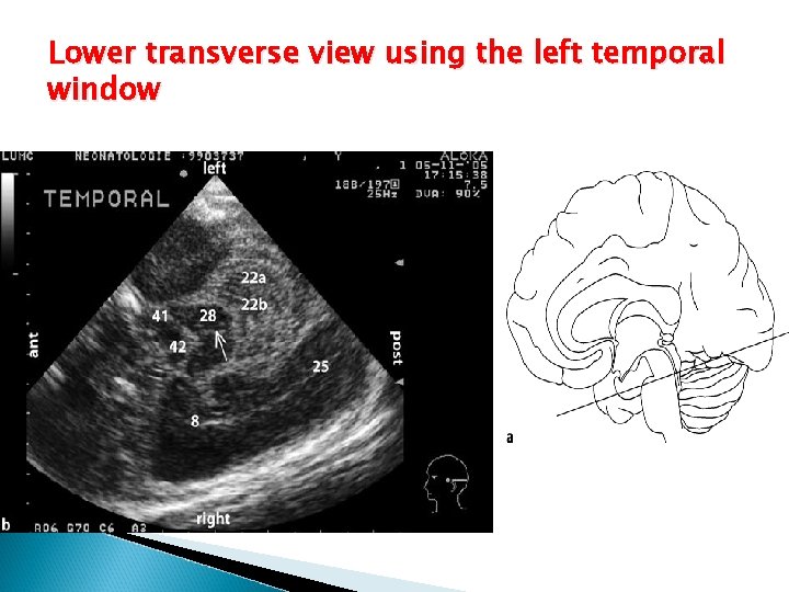 Lower transverse view using the left temporal window 