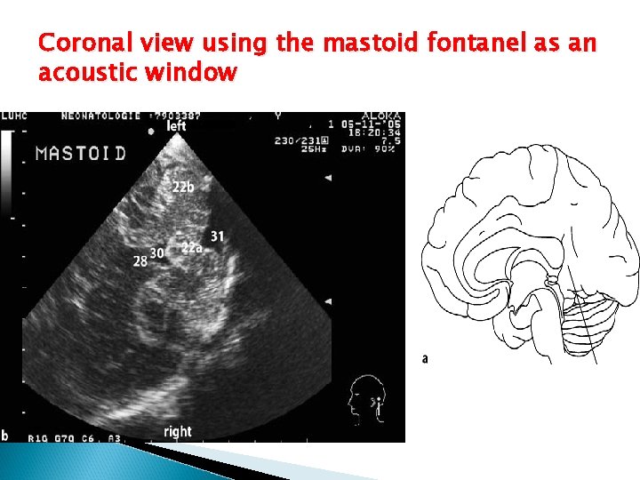 Coronal view using the mastoid fontanel as an acoustic window 
