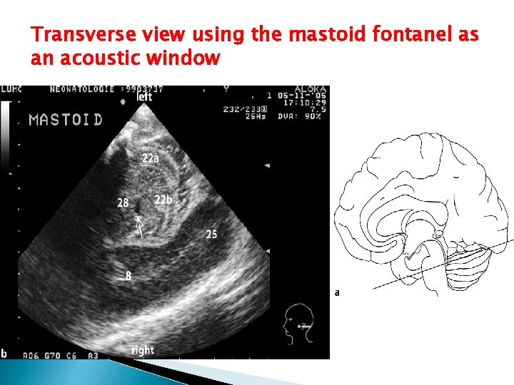 Transverse view using the mastoid fontanel as an acoustic window 