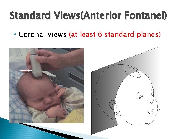Standard Views(Anterior Fontanel) Coronal Views (at least 6 standard planes) 