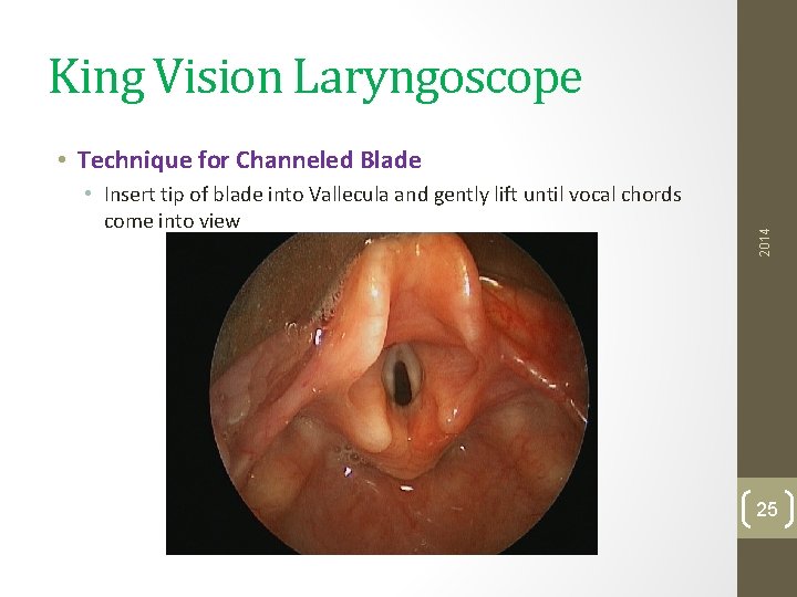 King Vision Laryngoscope • Insert tip of blade into Vallecula and gently lift until