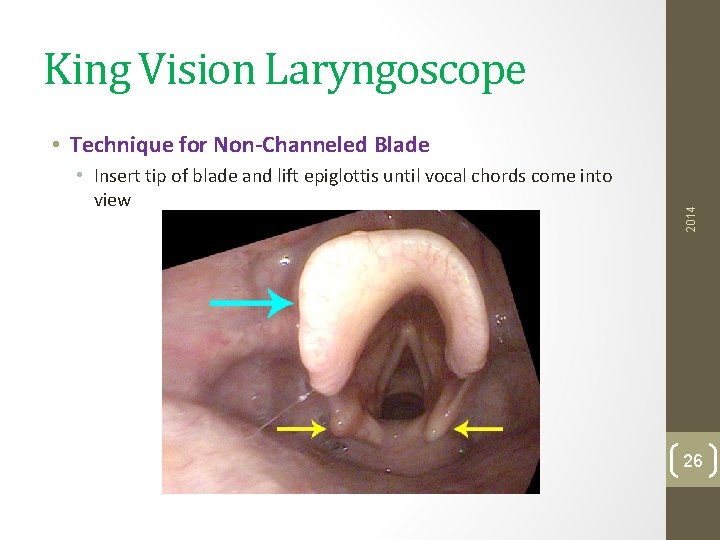 King Vision Laryngoscope • Insert tip of blade and lift epiglottis until vocal chords
