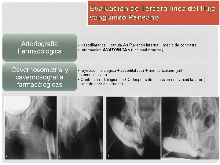 Evaluacion de Tercera linea del flujo sanguineo Peneano Arteriografía Farmacólogica Cavernosometría y cavernosografía farmacólogicas