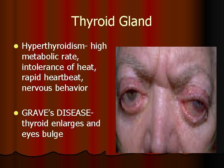 Thyroid Gland l Hyperthyroidism- high metabolic rate, intolerance of heat, rapid heartbeat, nervous behavior