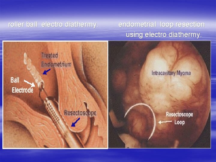  roller ball electro diathermy. endometrial loop resection using electro diathermy. 