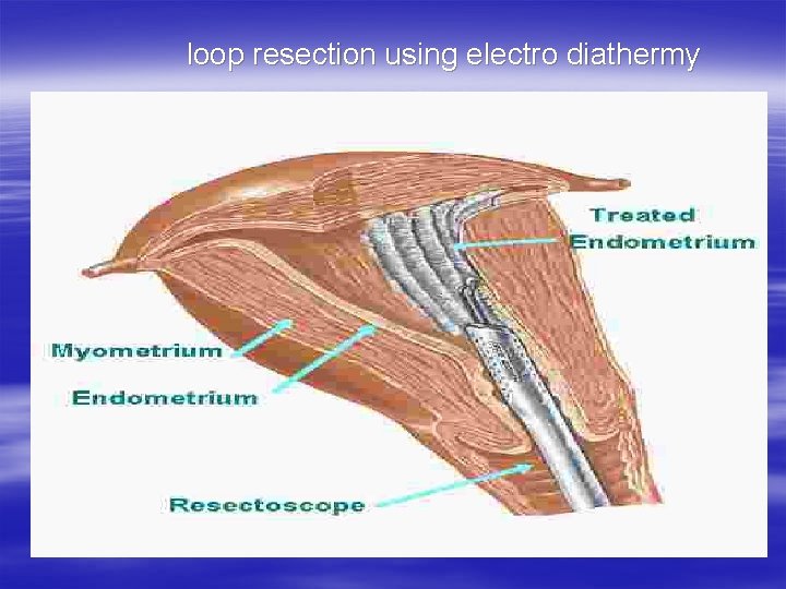  loop resection using electro diathermy 