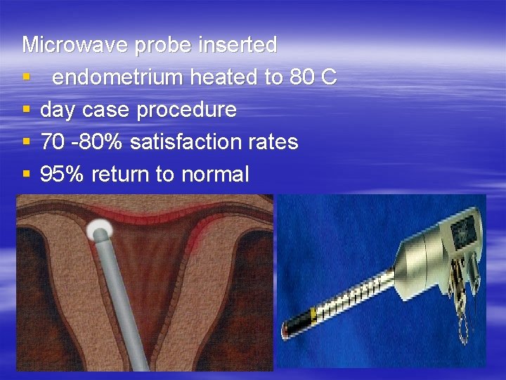 Microwave probe inserted § endometrium heated to 80 C § day case procedure §