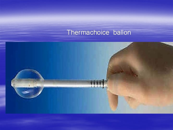  Thermachoice ballon Fig. The 3 - Thermachoice The Caveterm System 