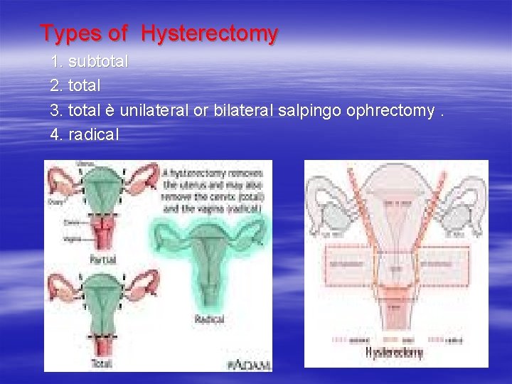  Types of Hysterectomy 1. subtotal 2. total 3. total è unilateral or bilateral