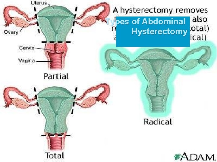 Types of Abdominal Hysterectomy 