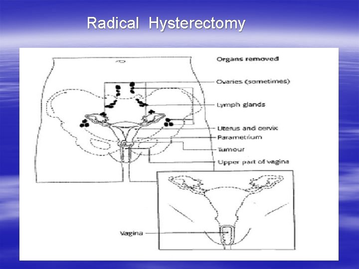  Radical Hysterectomy 