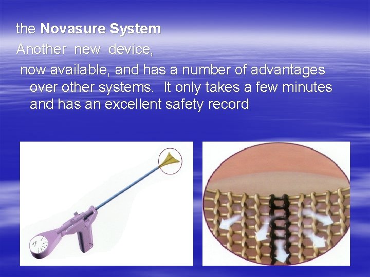  the Novasure System Another new device, now available, and has a number of