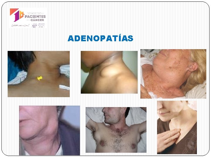 ADENOPATÍAS 