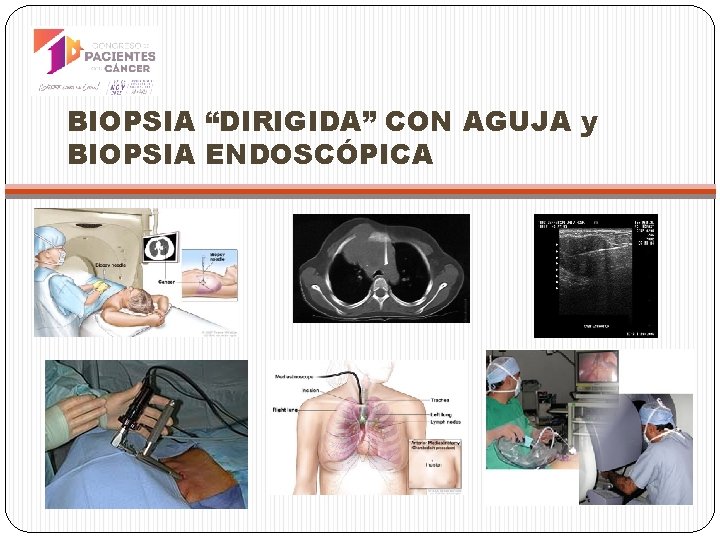 BIOPSIA “DIRIGIDA” CON AGUJA y BIOPSIA ENDOSCÓPICA 