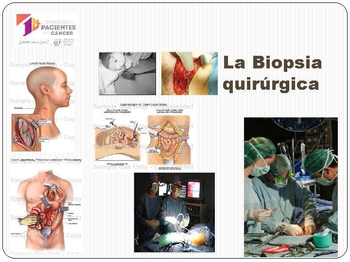 La Biopsia quirúrgica 