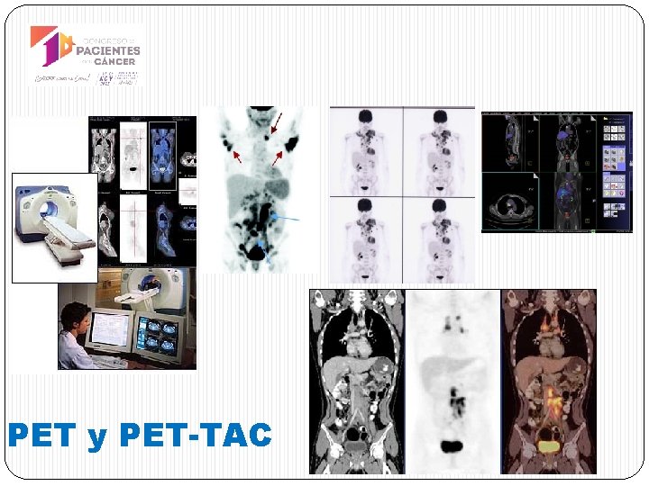 PET y PET-TAC 