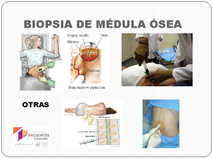 BIOPSIA DE MÉDULA ÓSEA OTRAS 