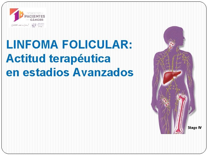 LINFOMA FOLICULAR: Actitud terapéutica en estadios Avanzados 