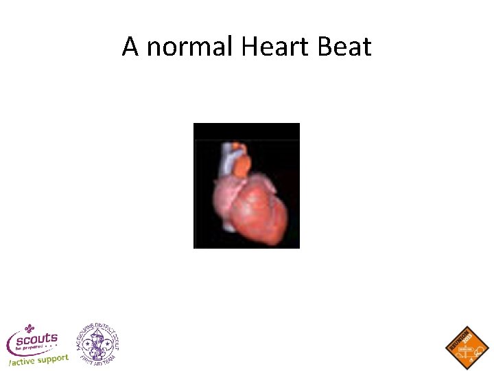 A normal Heart Beat A normal Heart Beat