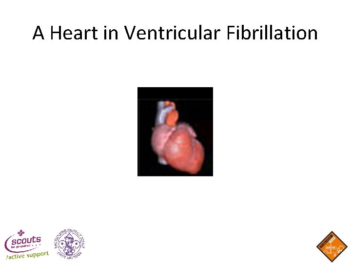A Heart in Ventricular Fibrillation A Heart in Ventricular Fibrillation