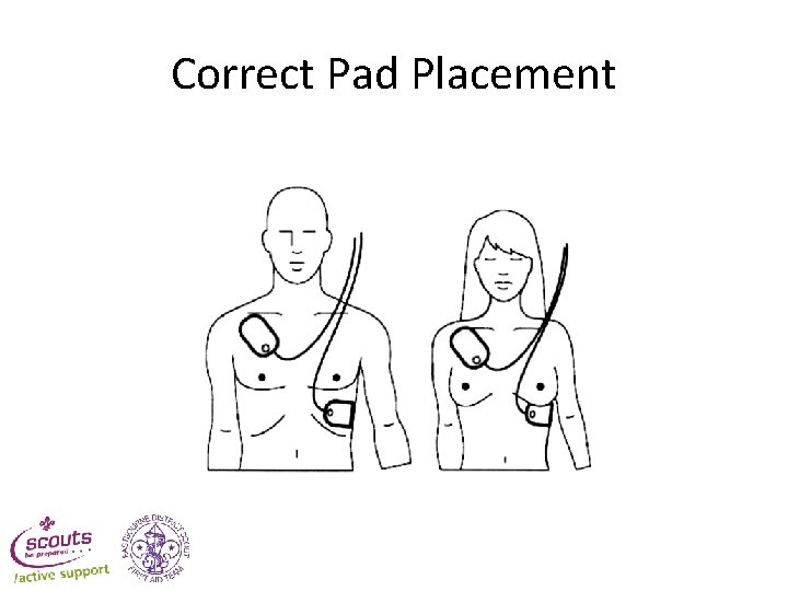 Correct Pad Placement Correct Pad Placement