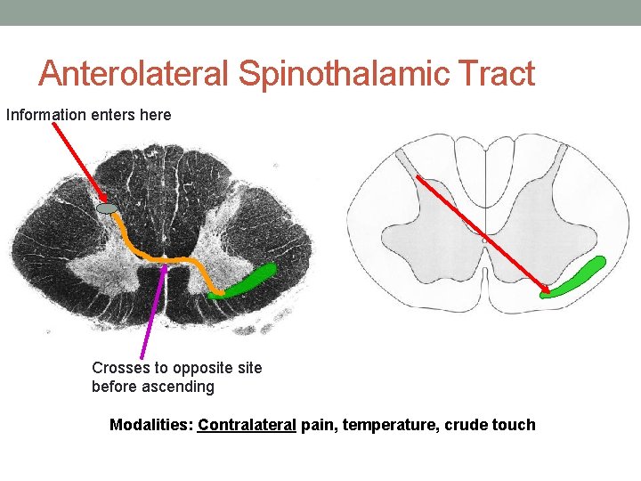 Anterolateral Spinothalamic Tract Information enters here Crosses to opposite before ascending Modalities: Contralateral pain,