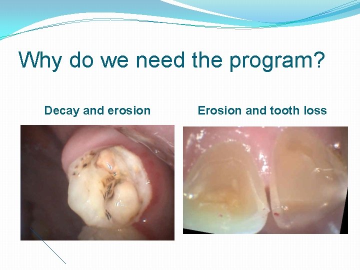 Why do we need the program? Decay and erosion Erosion and tooth loss 