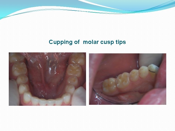 Cupping of molar cusp tips 