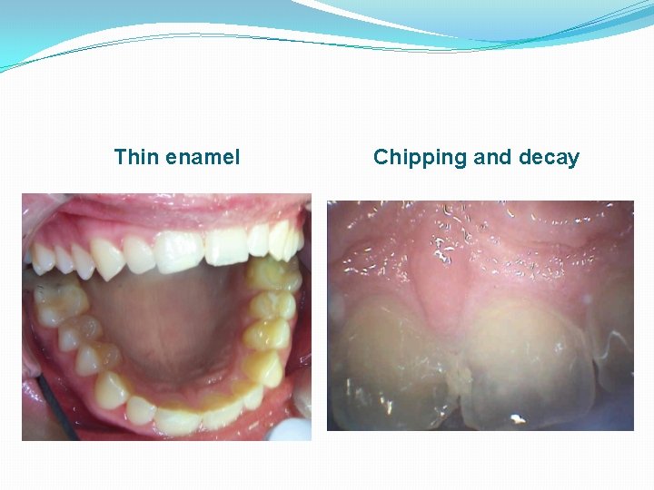 Thin enamel Chipping and decay 