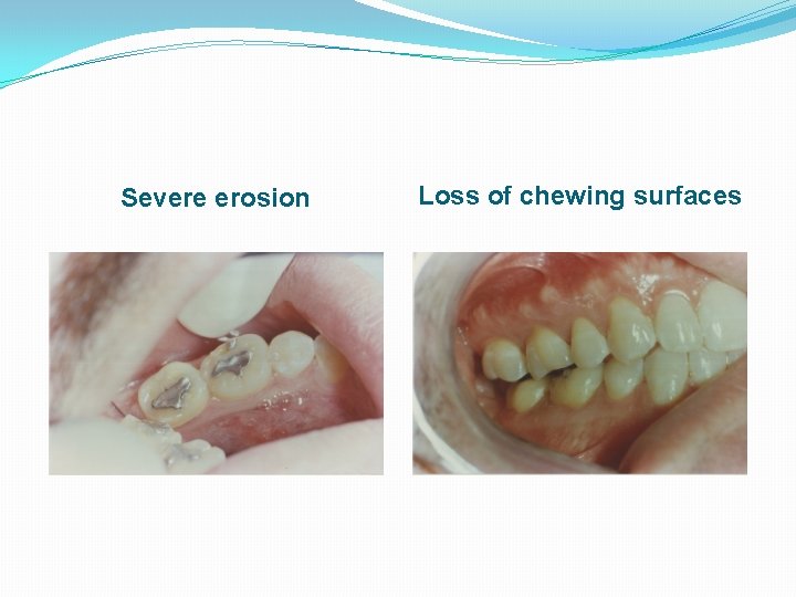 Severe erosion Loss of chewing surfaces 